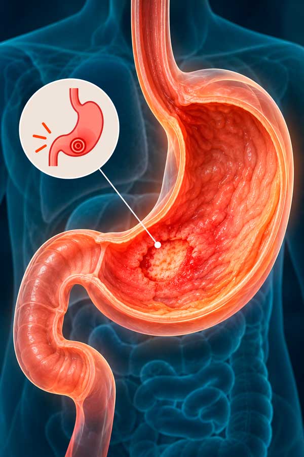 Ilustración del estómago en sección con una úlcera en la mucosa gástrica.