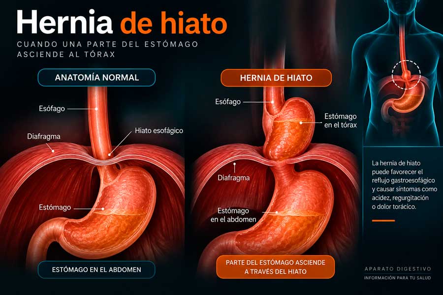 Anatomía y tratamiento de la hernia de hiato Infografía de la hernia de hiato con comparación entre anatomía normal y estómago en el tórax